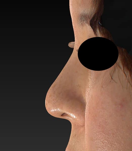鼻尖縮小（3Ｄ法）、軟骨移植　半年後のAfterの写真