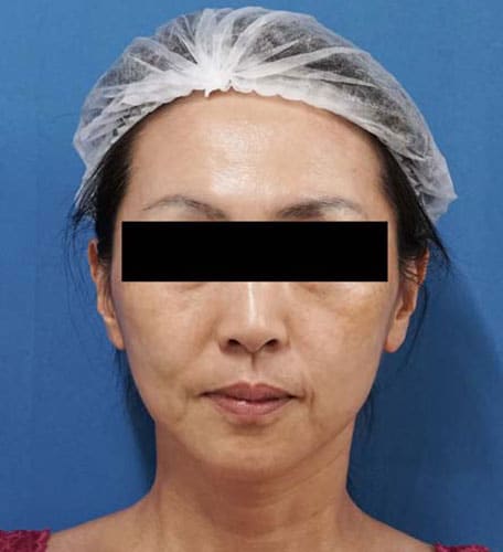 鼻尖縮小＋軟骨移植＋ストラット、鼻翼縮小（内＋外）　３ヶ月後　正面のBefore写真