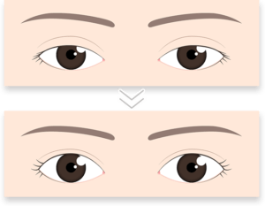眼瞼下垂の改善イメージ