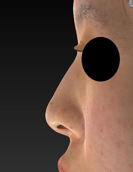 鼻尖縮小＋軟骨移植＋ストラット、鼻翼縮小（内＋外）　３ヶ月後　正面のBefore写真