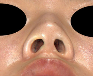 下から手術前-鼻尖縮小＋軟骨移植＋プロテーゼ-
