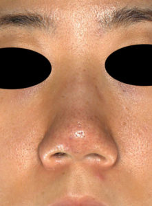 正面術前-鼻尖縮小(3D法)＋軟骨移植