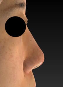 右側面術前　鼻尖縮小(3D法)＋軟骨移植