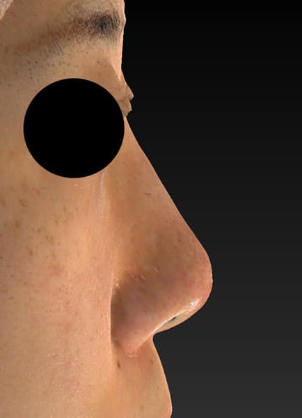 鼻尖縮小（３Ｄ法）、軟骨移植　3ヶ月後のBefore写真