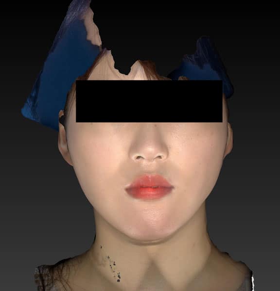 小顔脂肪吸引（ホホ・アゴ下・ほうれい線上）　3ヶ月後のAfter写真
