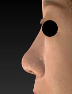 術後　左側面　鼻尖縮小(3D法)＋軟骨移植