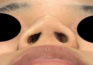 下から　術前　鼻翼縮小(内＋外側法)