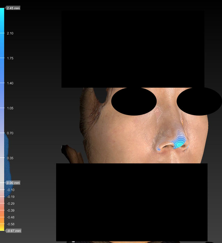 術前後変化カラー　鼻尖縮小(3D法)＋軟骨移植