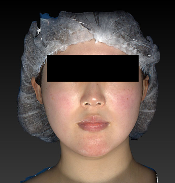 鼻尖縮小＋軟骨移植＋ストラット、鼻翼縮小（内＋外）　３ヶ月後　正面のBefore写真