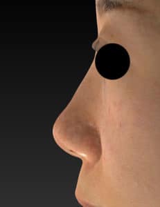 術前　左側面　鼻尖縮小(3D法)＋軟骨移植
