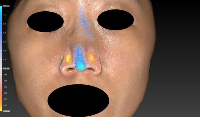 高低変化　鼻尖縮小(3D法)＋軟骨移植