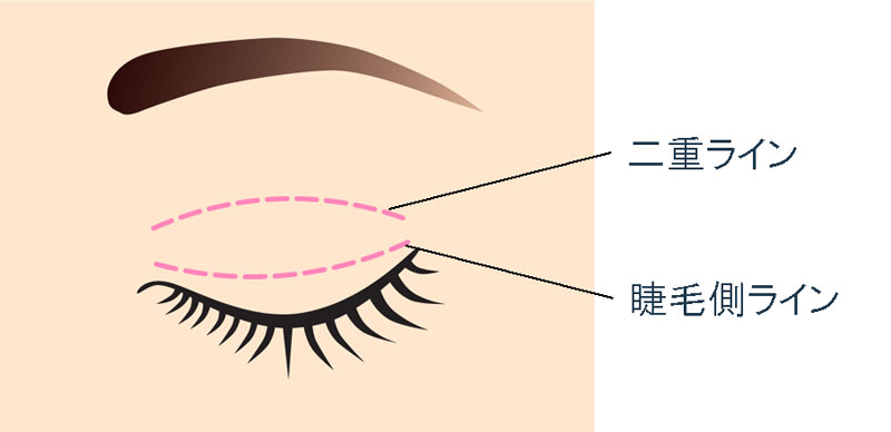目の上のたるみ取り切開位置