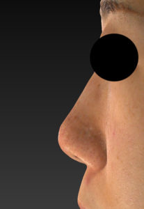 左側面術前　鼻尖縮小(3D法)＋軟骨移植