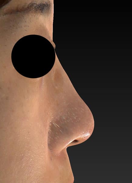 鼻尖縮小（３Ｄ法）、軟骨移植　3ヶ月後のAfterの写真