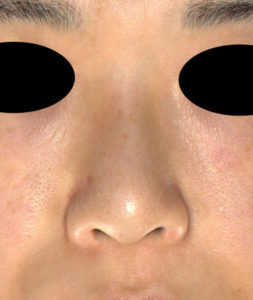 正面　術前　-鼻尖縮小＋軟骨移植＋ストラット