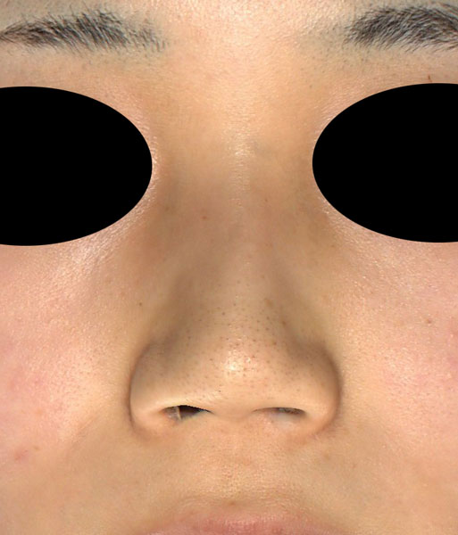 正面　術前　鼻翼縮小(内＋外側法)