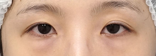 切らない眼瞼下垂　1ヶ月後のBefore写真