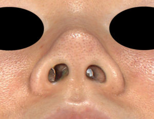 鼻尖縮小、軟骨移植　下から　手術前