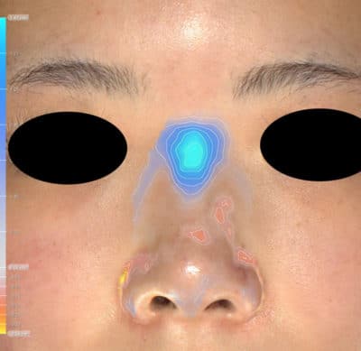 鼻ヒアルロン酸（クレヴィエルコントア）　1週間後　鼻根高さ色変化