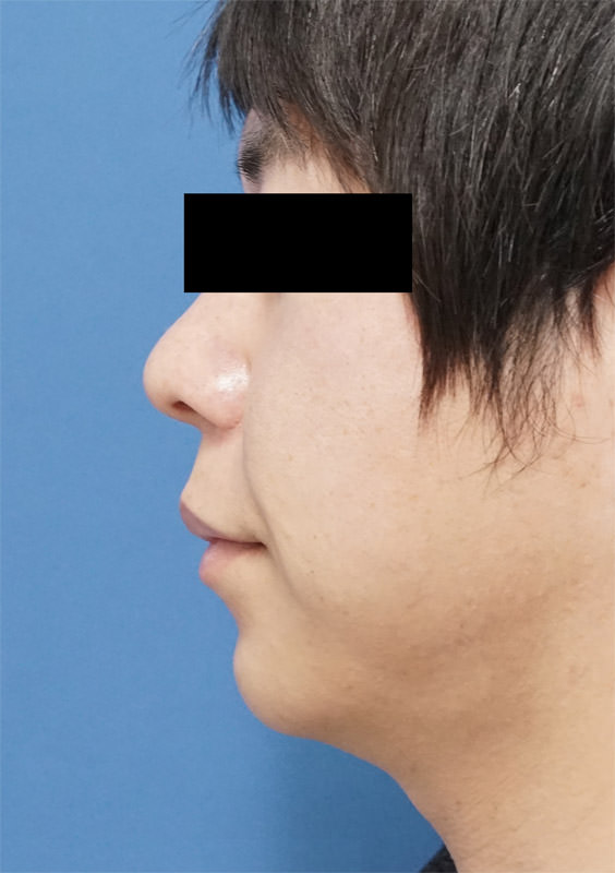 クレヴィエル（アゴ）　1週間後のAfterの写真