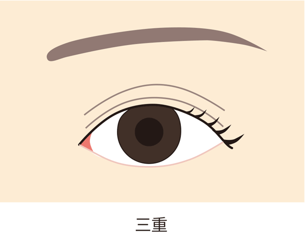 二重の上にラインがある三重を改善する方法