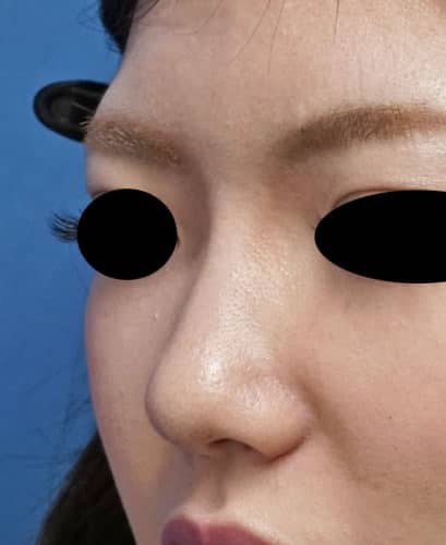 クレヴィエル（鼻）　１週間後のAfterの写真