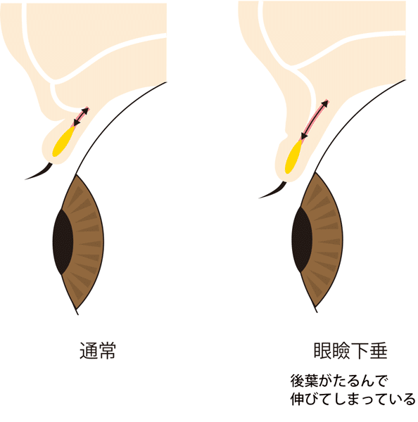 眼瞼下垂後葉のたるみの図