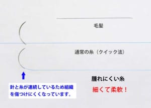 二重埋没法の腫れにくい糸