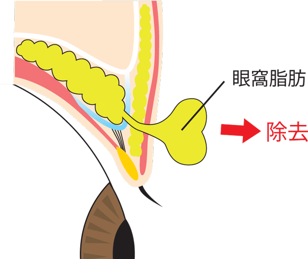 全切開二重眼窩脂肪除去