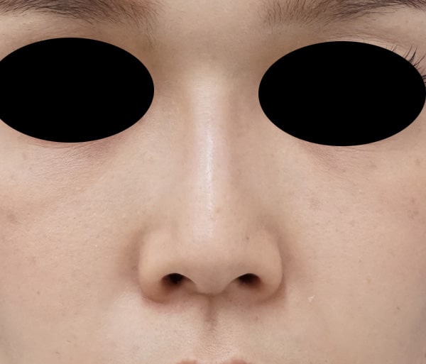 鼻筋へのクレヴィエル注入　処置前⇒一週間後のAfterの写真