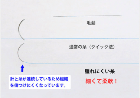 埋没法に使用する腫れにくい糸