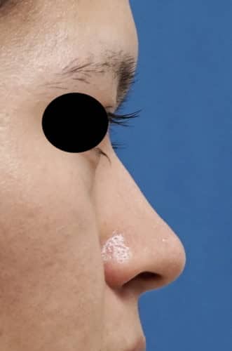 小鼻縮小（内側法、フラップ法）、Ｉ型鼻根プロテーゼ　１週間後のBefore写真