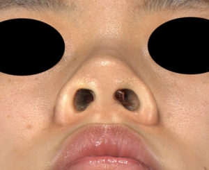 下から　術前　シモタケユカ-鼻尖縮小＋軟骨移植