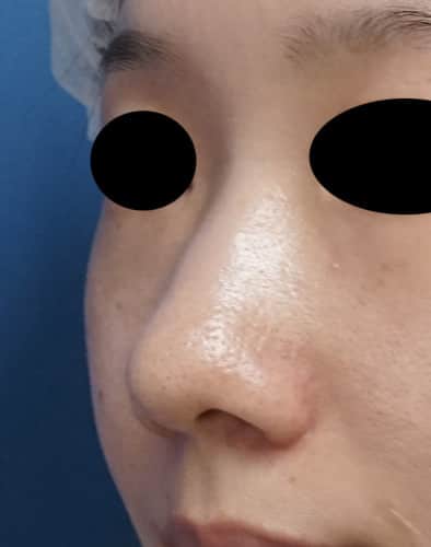 鼻尖形成、鼻尖部軟骨移植、flap法　5ヶ月後のBefore写真