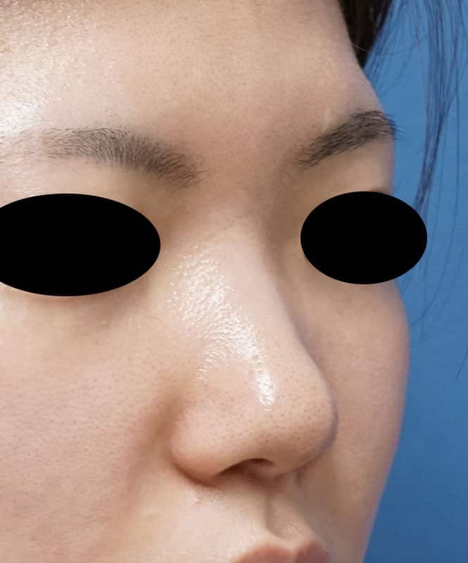 クレヴィエル（鼻）　１週間後のBefore写真