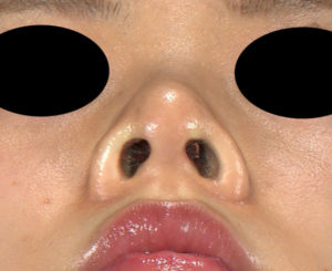 下から　1ヶ月後　シモタケユカ-鼻尖縮小＋軟骨移植
