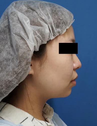 ホホ・アゴ脂肪吸引、強力小顔ボトックス　1ヵ月後のBefore写真