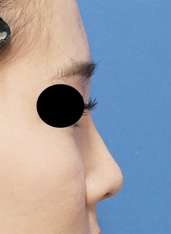 クレヴィエル(鼻根）1週間後のAfterの写真