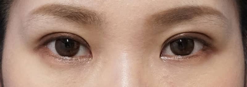 もとびアイゴールド　手術前～3ヶ月後の経過のAfterの写真