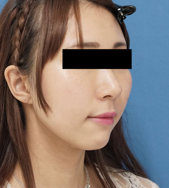 クレヴィエル（アゴ）　1週間後のBefore写真