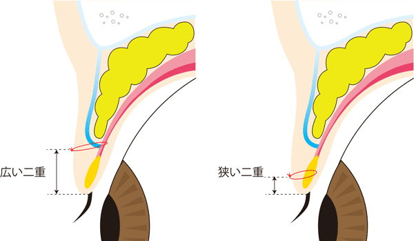 広い二重は挙筋法、狭い二重は瞼板法