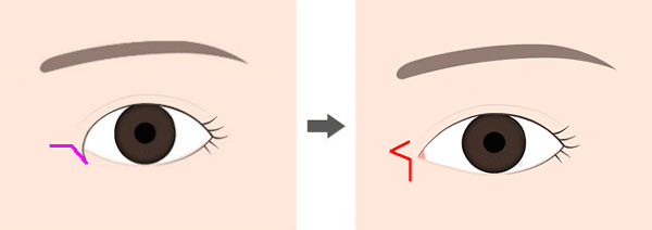 目頭切開Z形成 デカ目 目整形