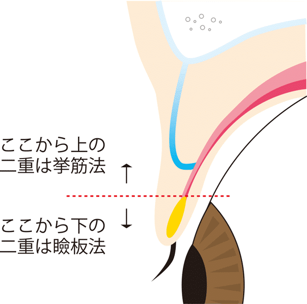 二重の幅によって瞼板法か挙筋法かが決まります。