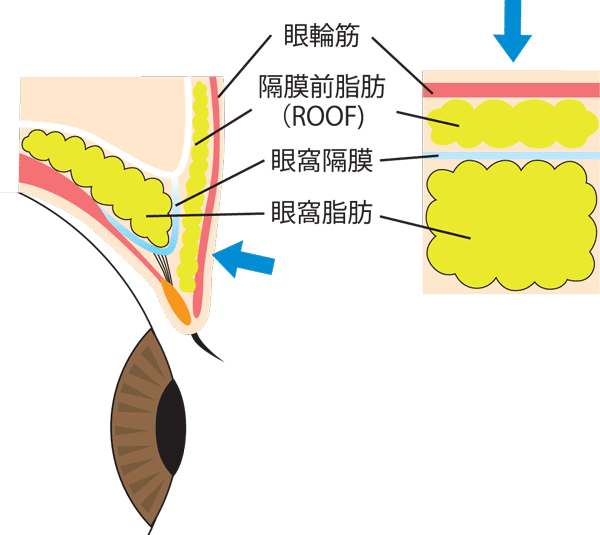 二重全切開メリット　図解