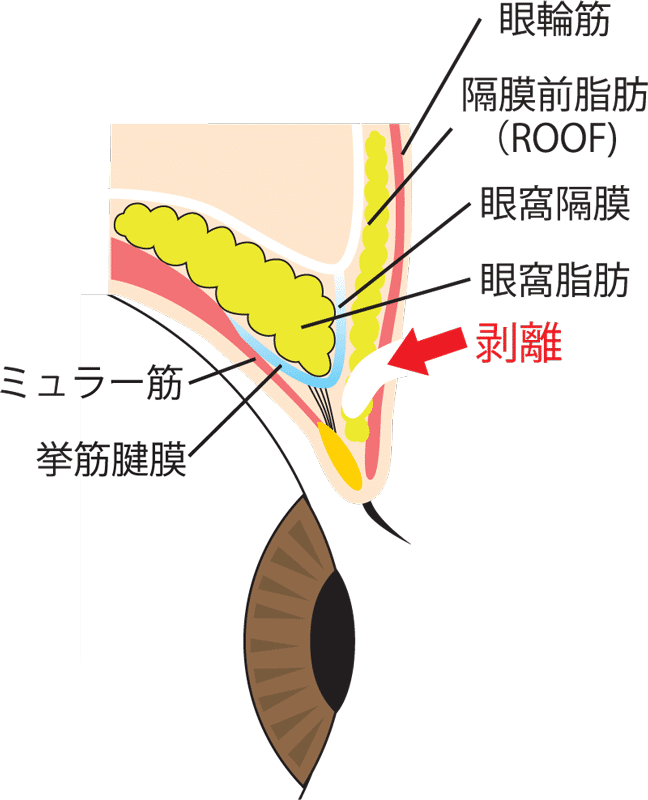 二重全切開剥離