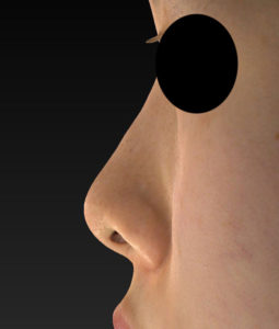 左側面　術前　シモタケユカ-鼻尖縮小＋軟骨移植