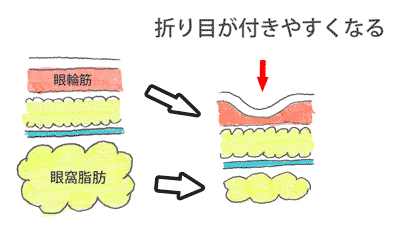 まぶたの厚み取り　眼窩脂肪　眼輪筋