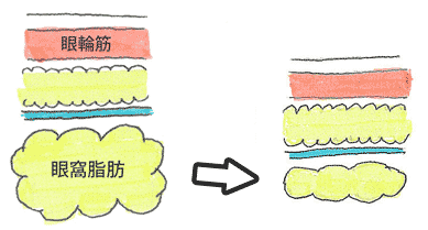 上まぶたの厚み取り　脂肪取り　埋没法