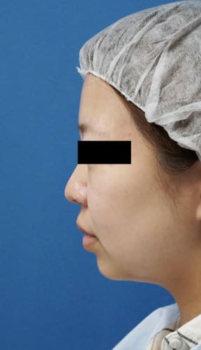 ホホ・アゴ脂肪吸引、強力小顔ボトックス　1ヵ月後のBefore写真
