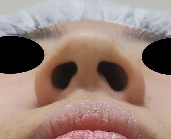 団子鼻をすっきり　鼻尖形成（3D法）　1か月後のBefore写真